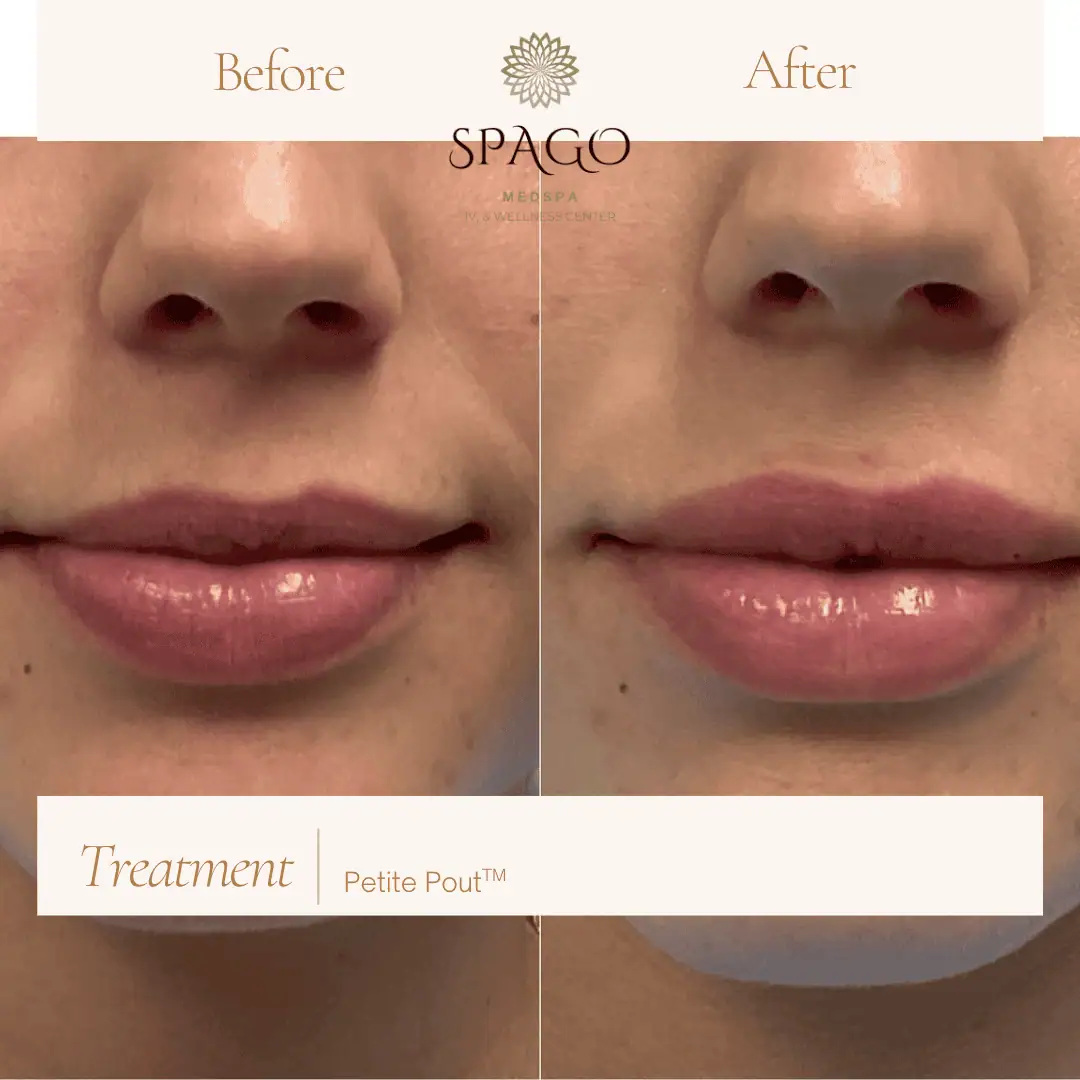 Lip Filler Before & After (32)