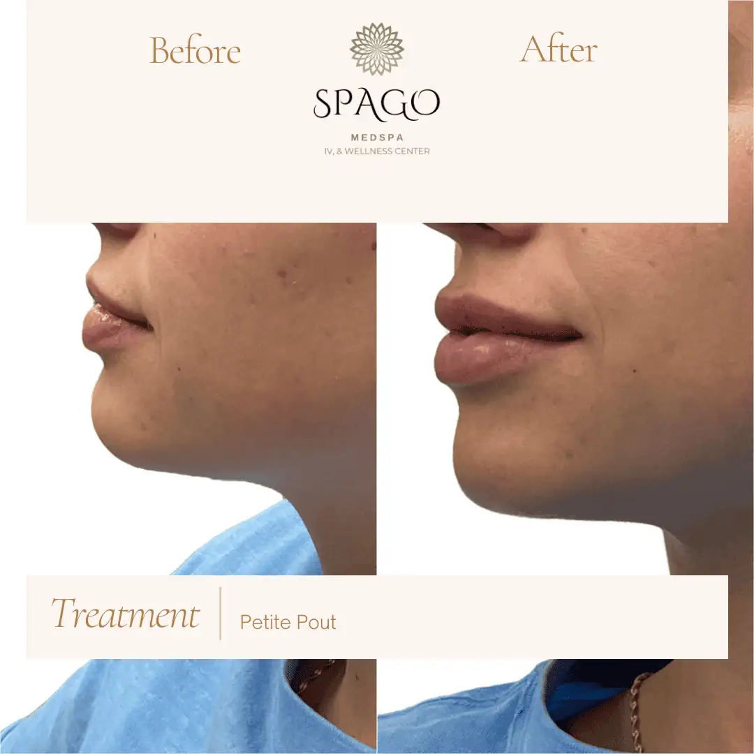Lip Filler Before & After (33)