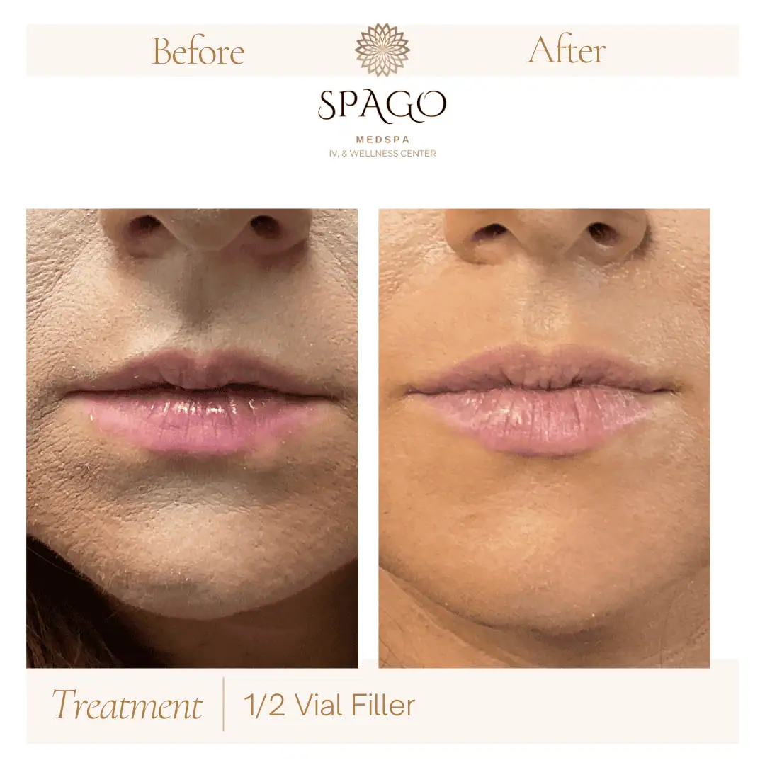 Lip Filler Before & After (34)
