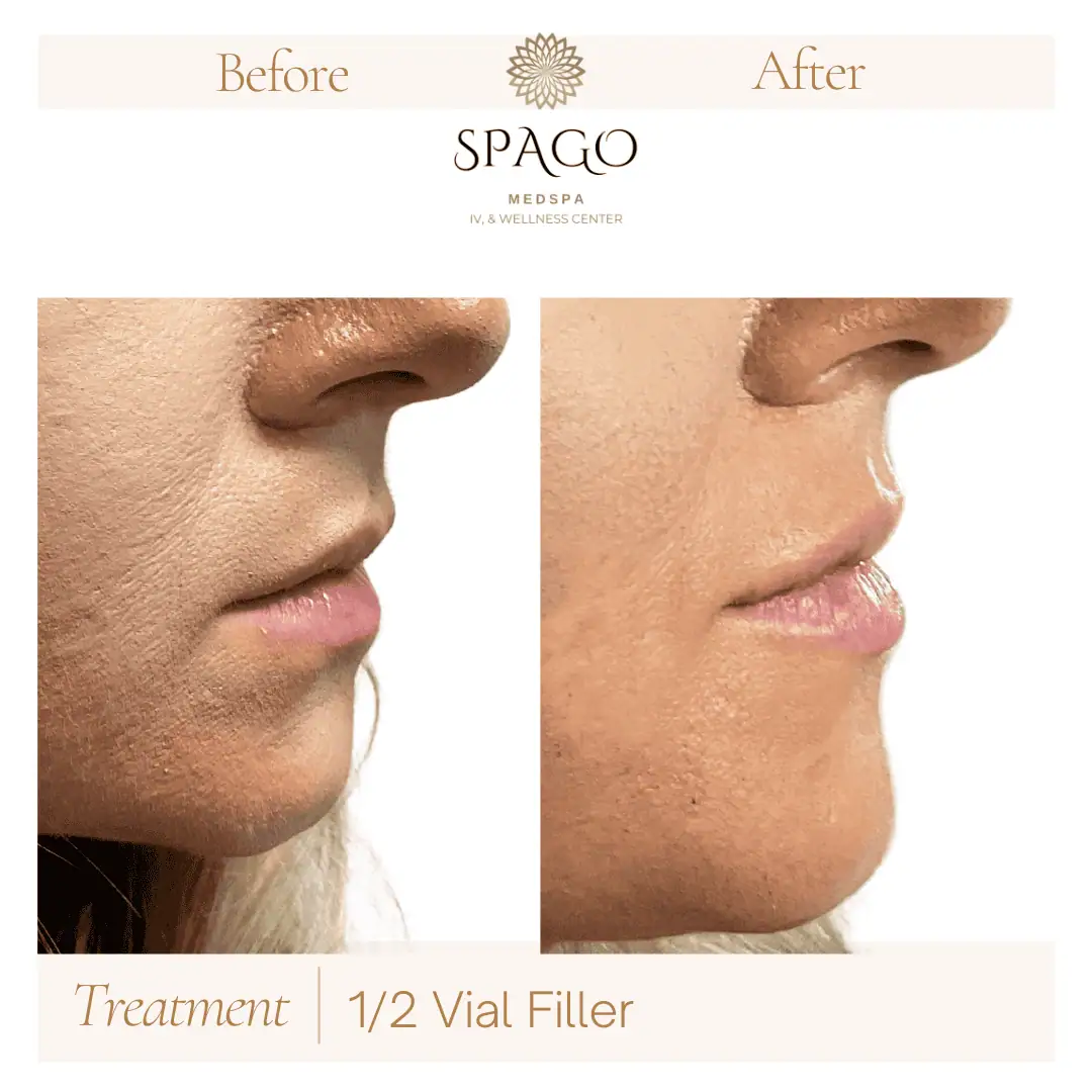 Lip Filler Before & After (35)