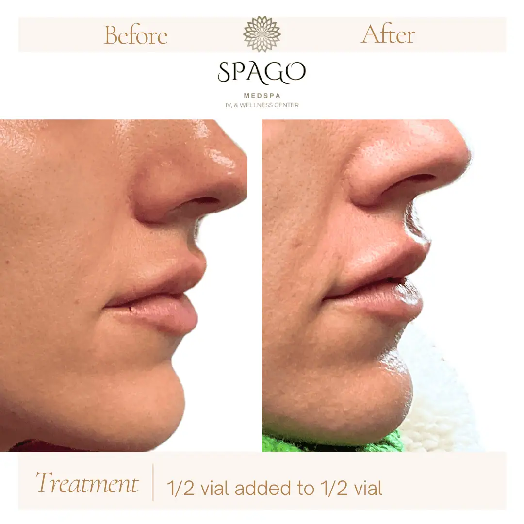 Lip Filler Before & After (36)