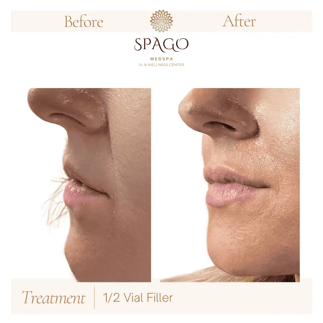 Lip Filler Before & After (4)