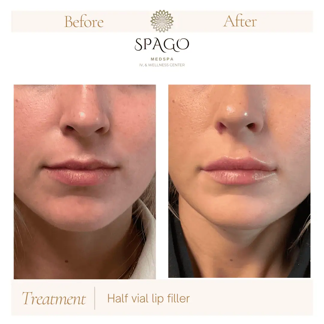 Lip Filler Before & After (5)