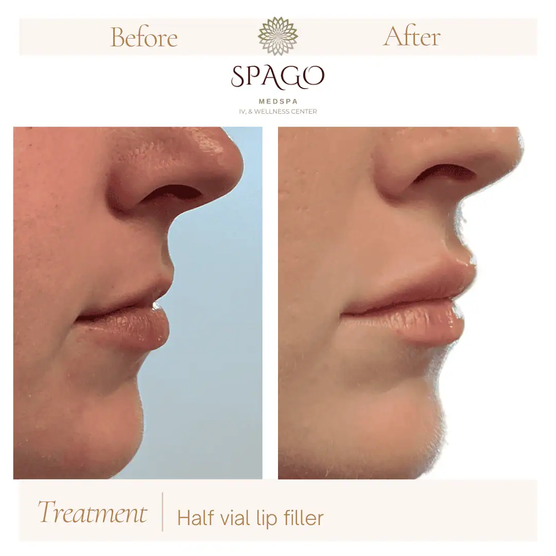 Lip Filler Before & After (6)