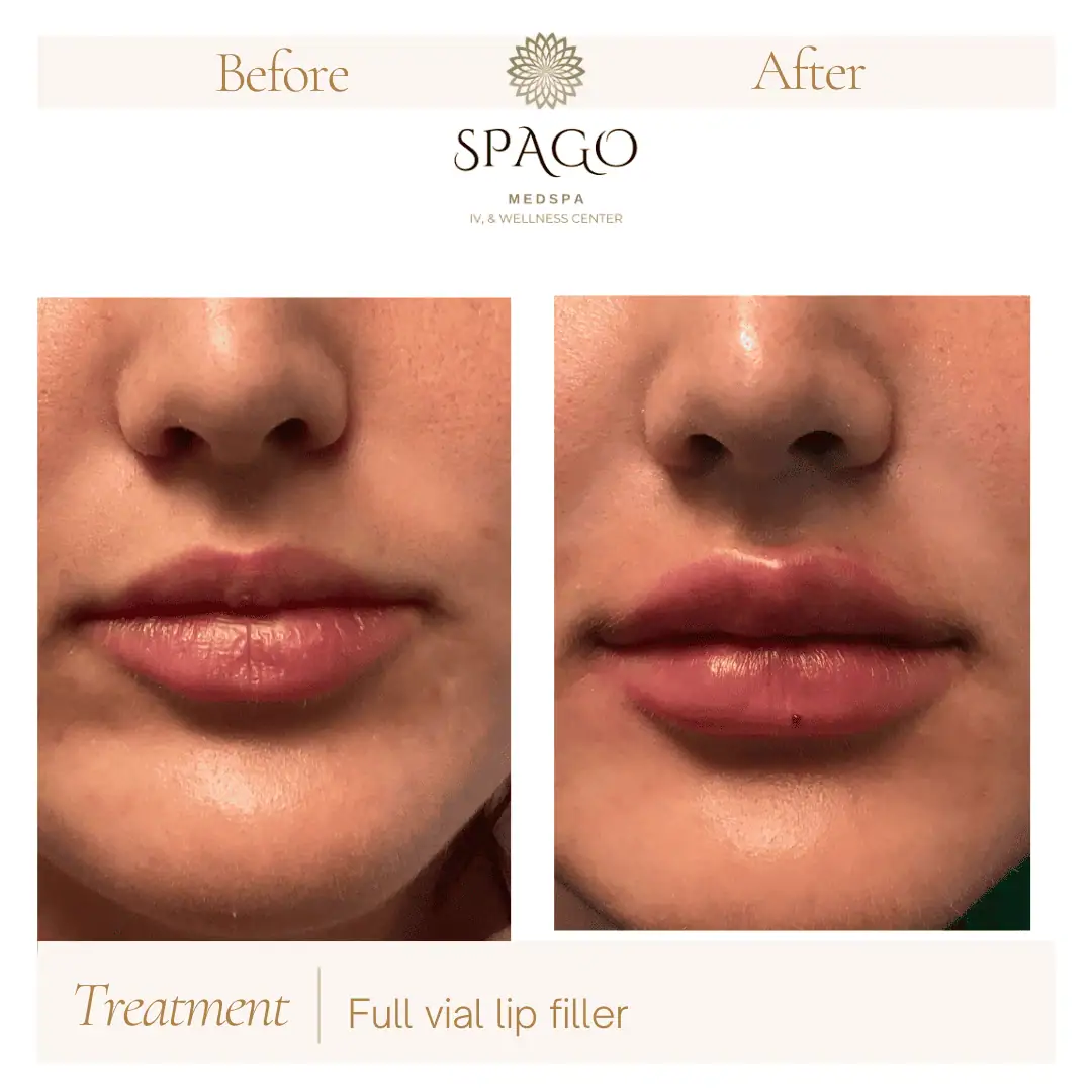 Lip Filler Before & After (7)