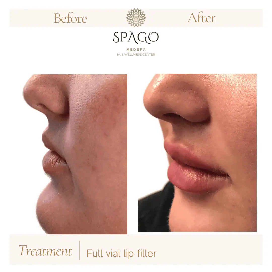 Lip Filler Before & After (8)