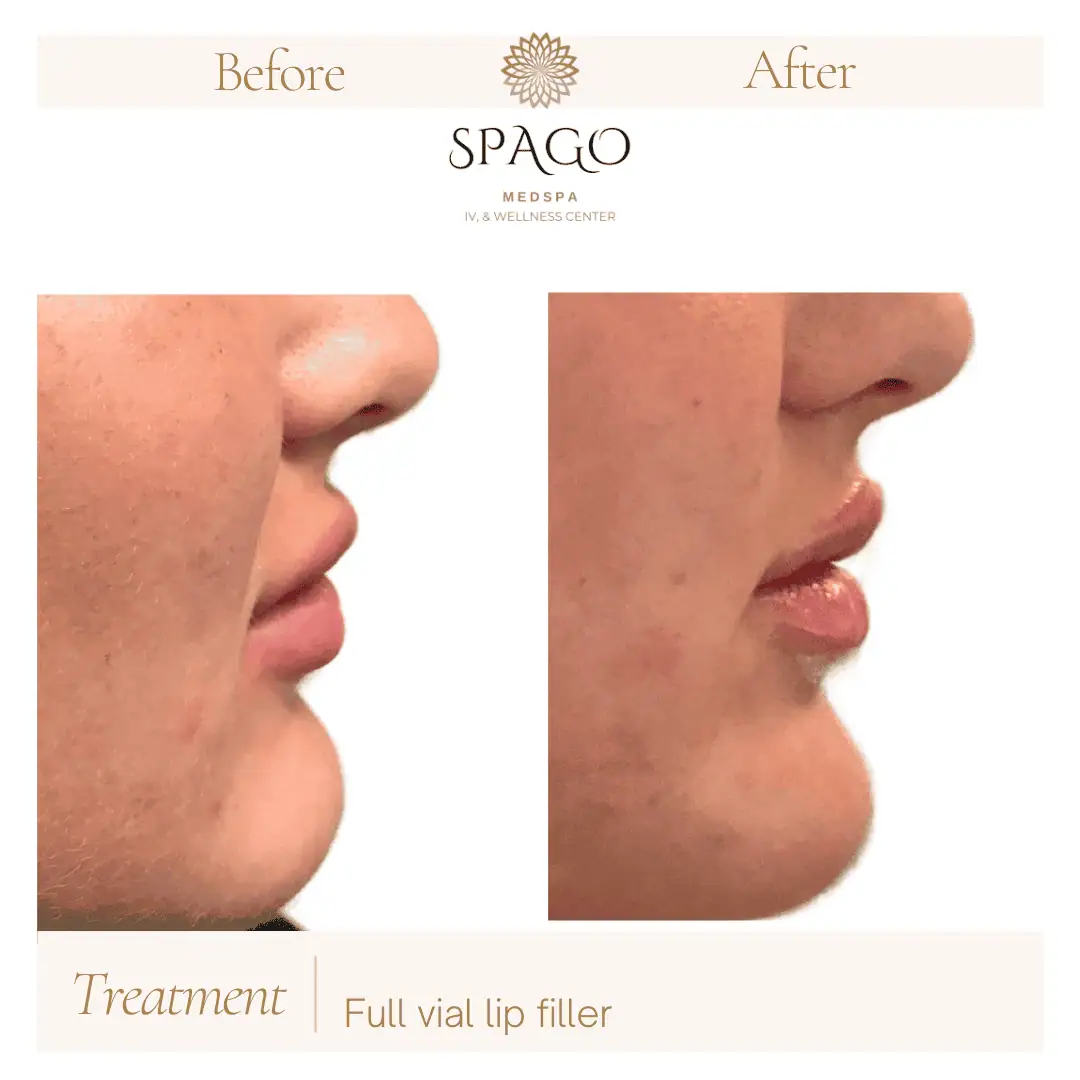 Lip Filler Before & After (9)
