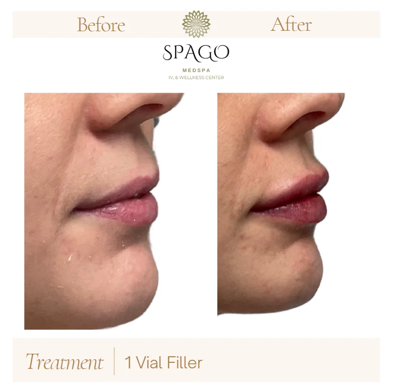 Lip Filler Before & After