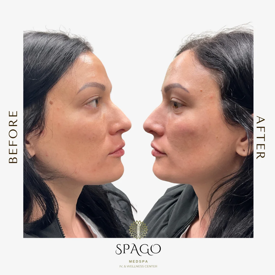 MIDFACE ANDLIPS before after