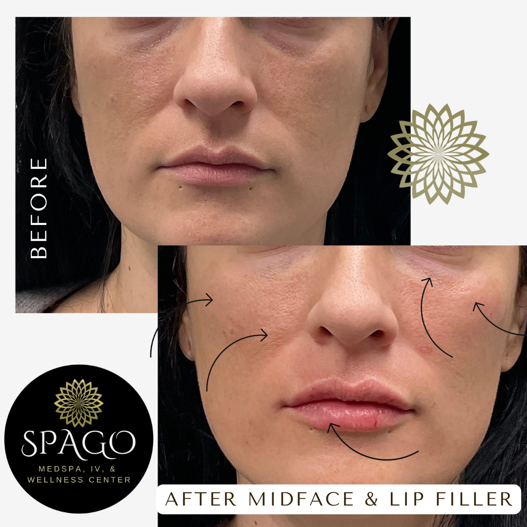 MIDFACE VOLUME LOSS (1)