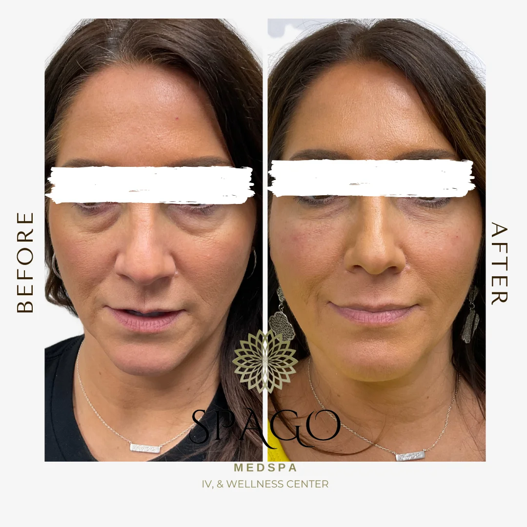 Under eye before after