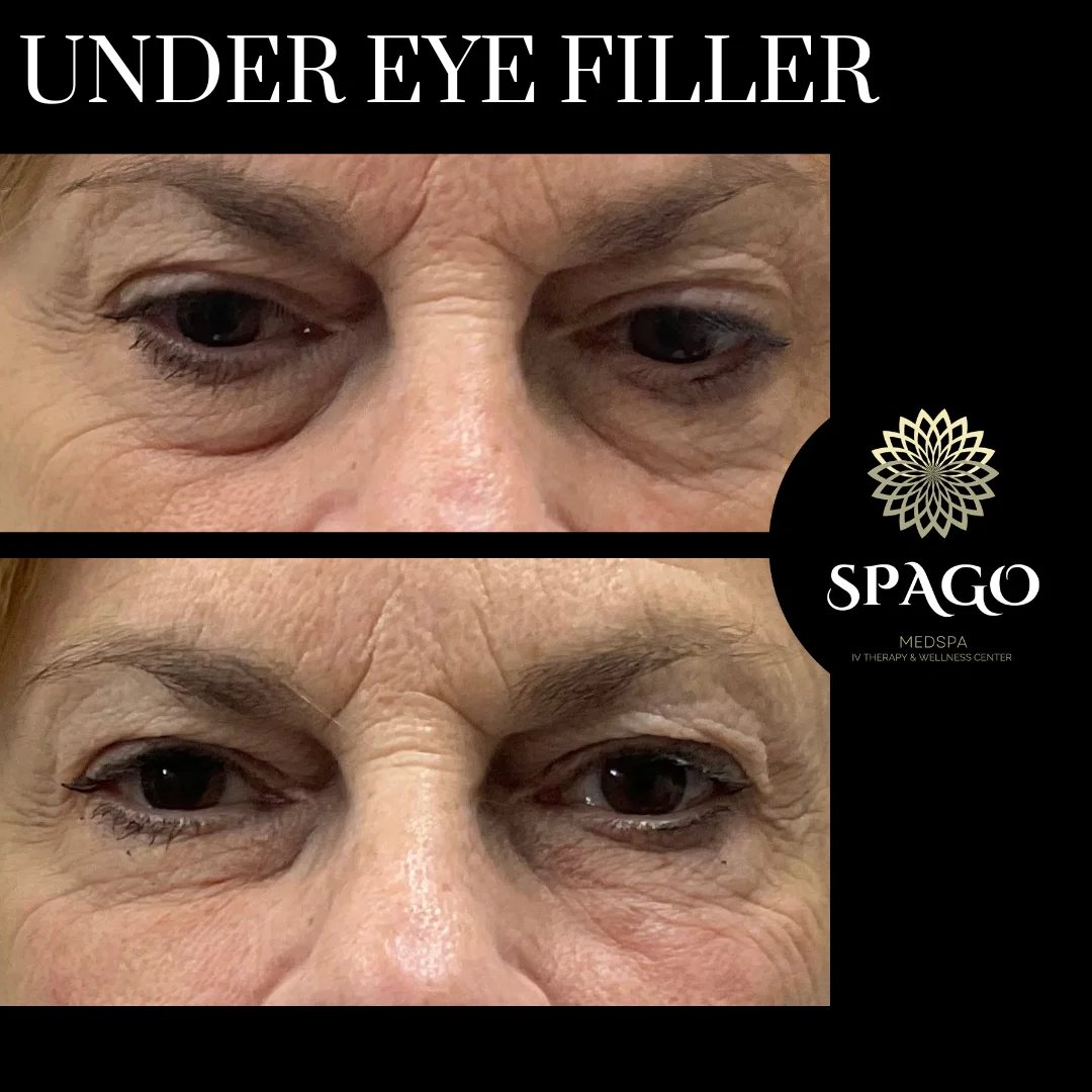 Under-eye before after