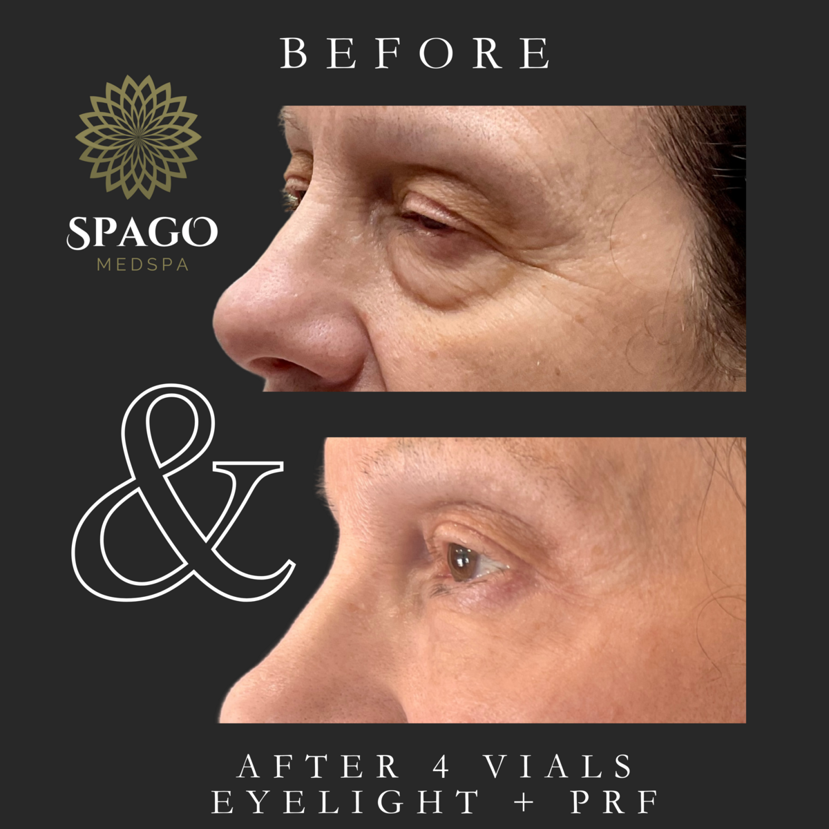 eye filler (1)