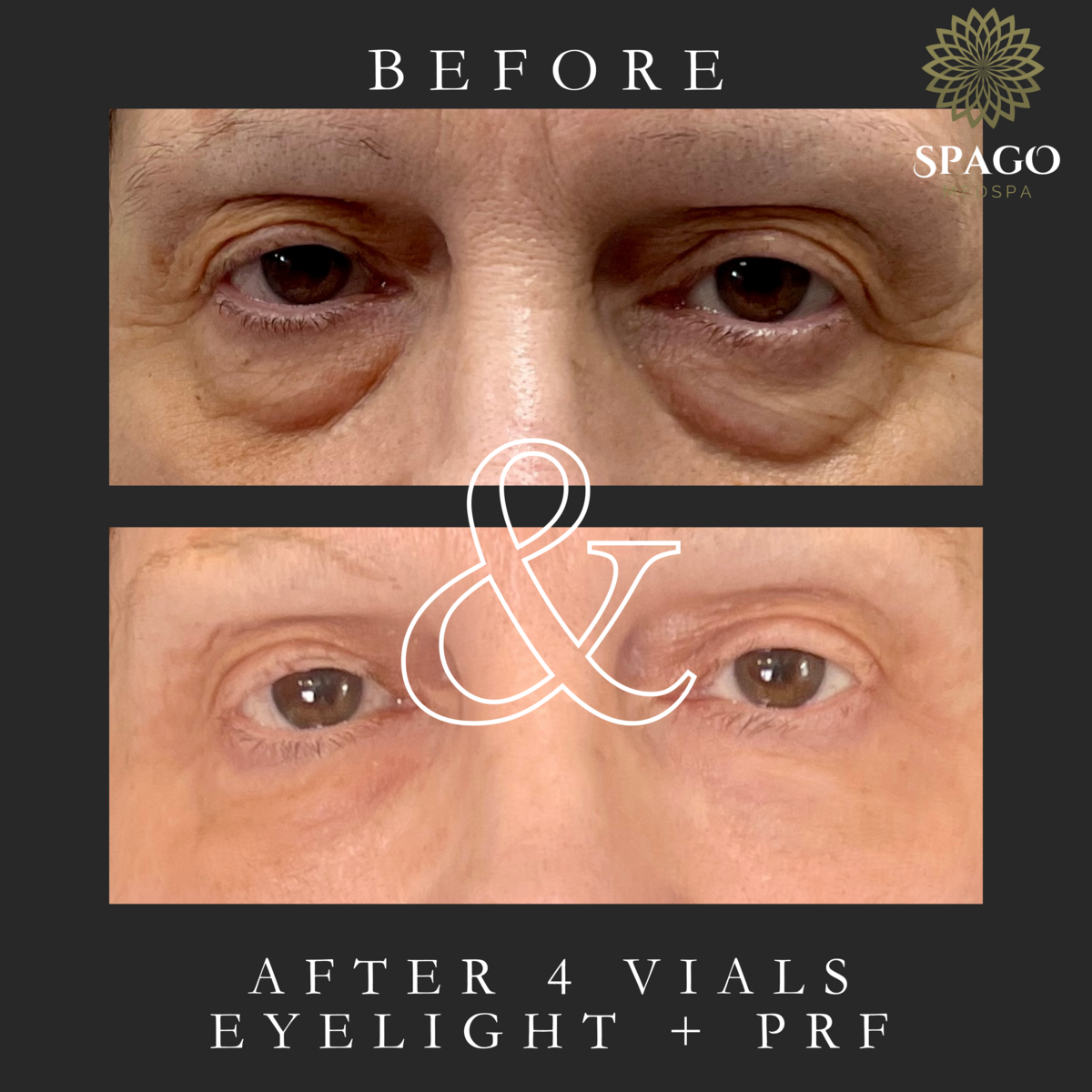 eyefiller (1)