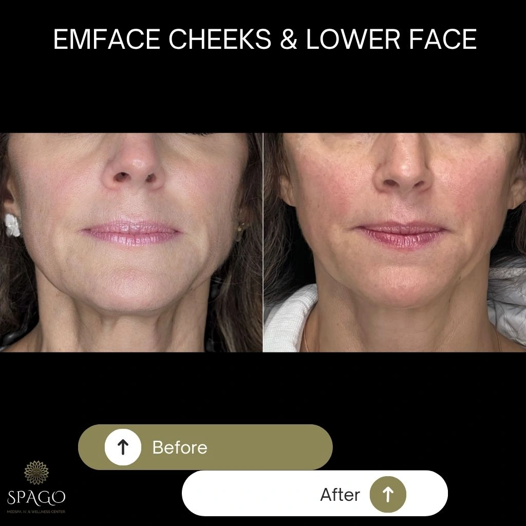EMFACE SUBMENTUM (10)