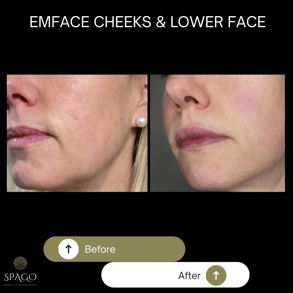 EMFACE SUBMENTUM (11)