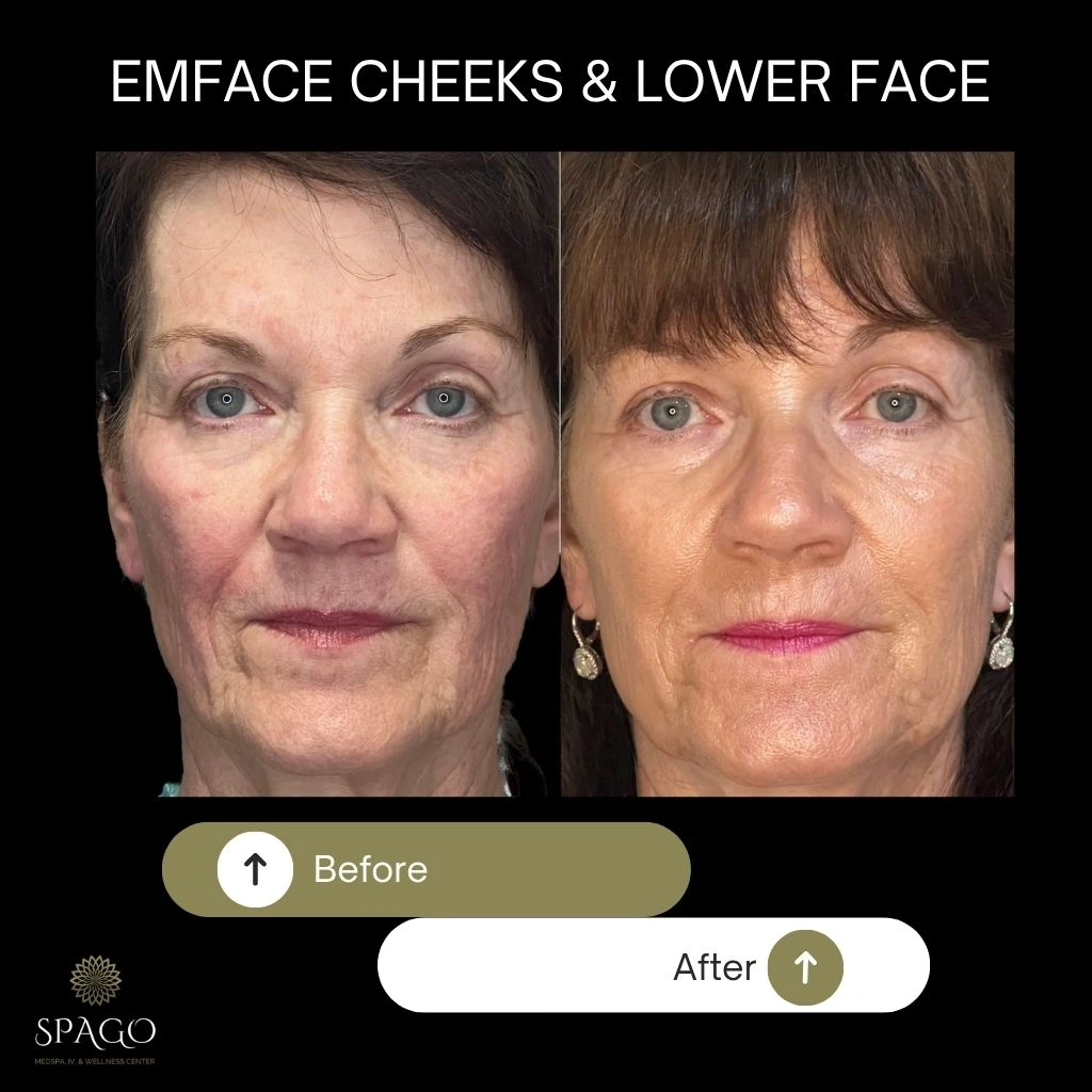 EMFACE SUBMENTUM (2)