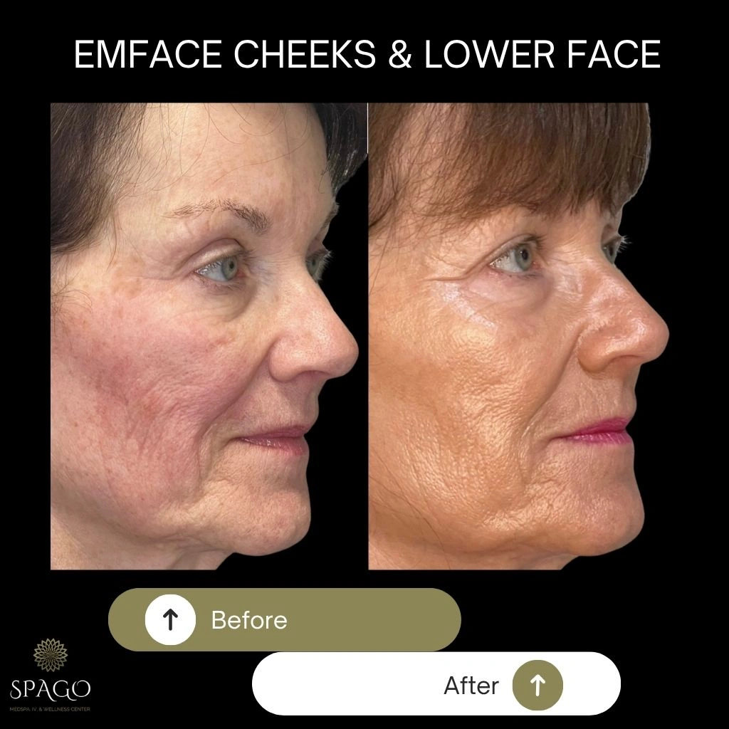 EMFACE SUBMENTUM (3)