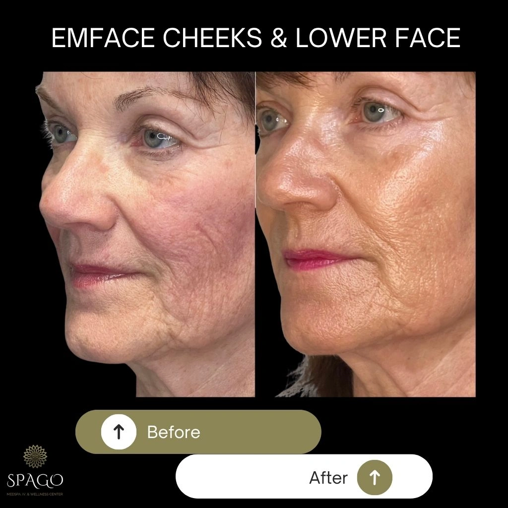 EMFACE SUBMENTUM (4)