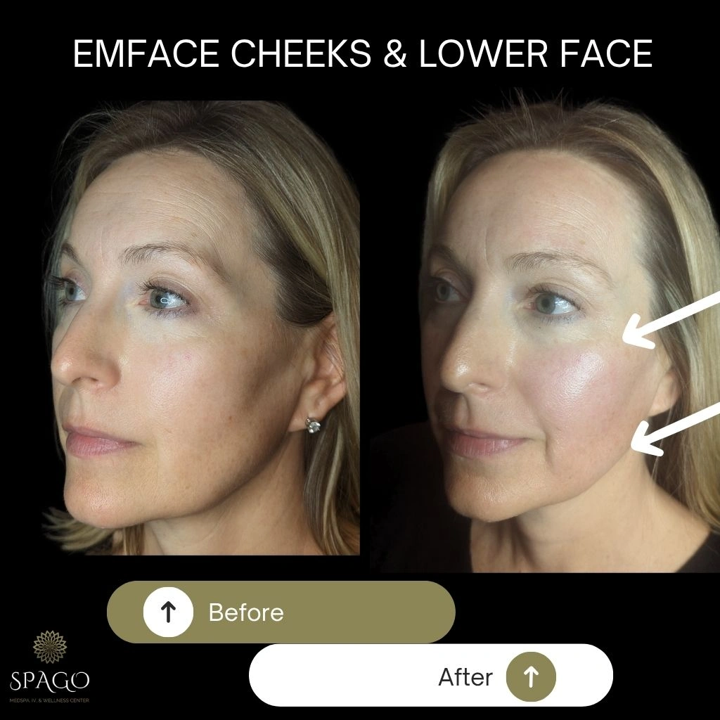 EMFACE SUBMENTUM (5)