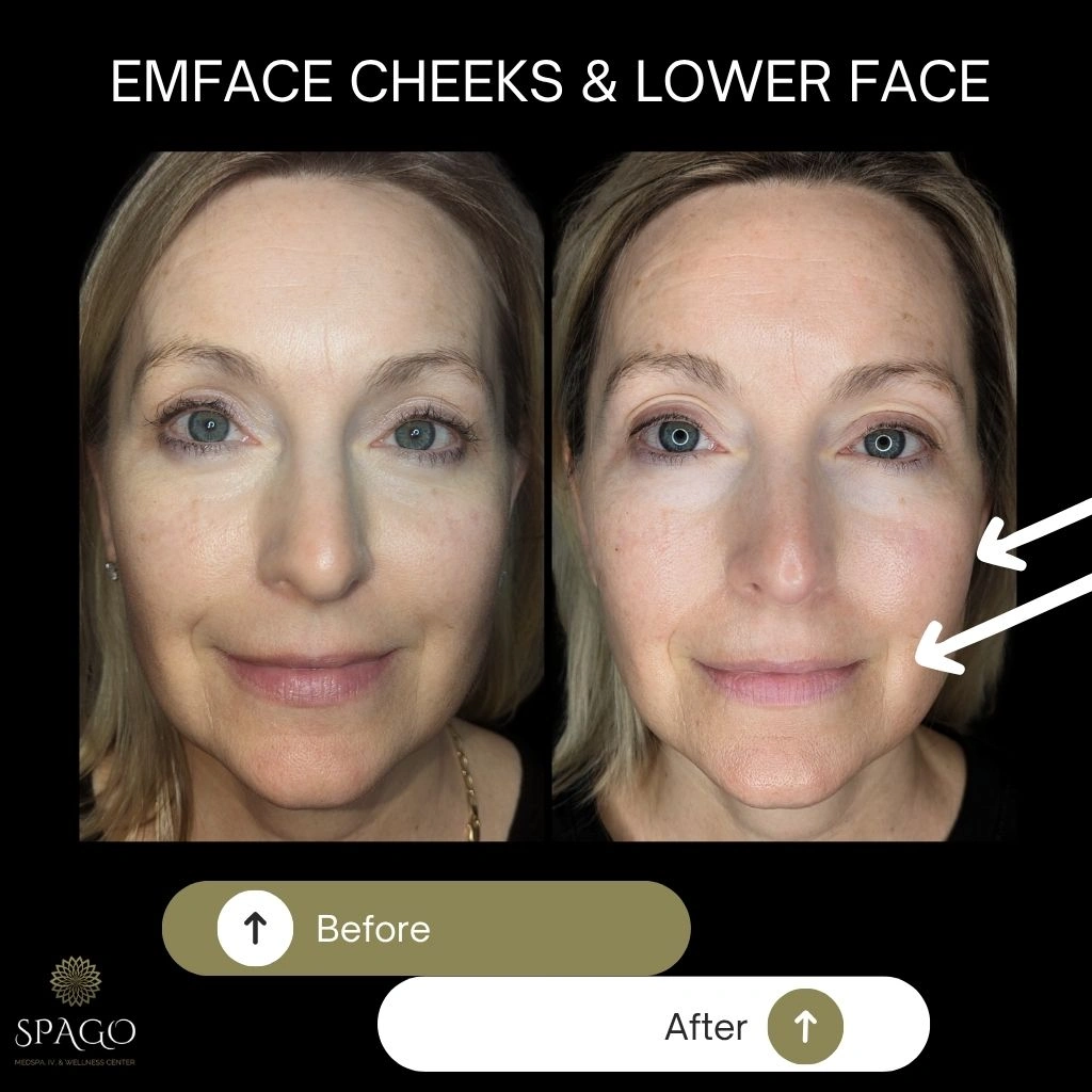 EMFACE SUBMENTUM (6)