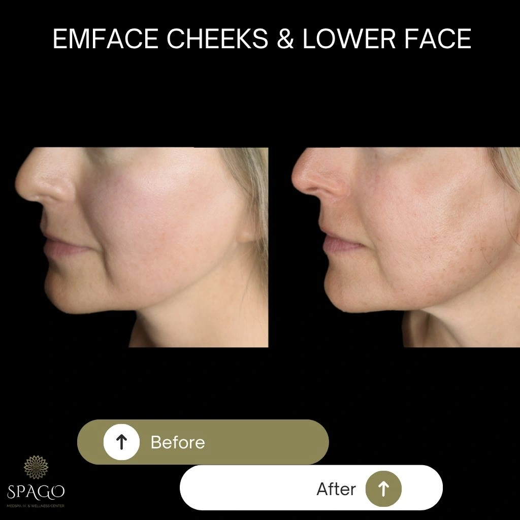 EMFACE SUBMENTUM (7)