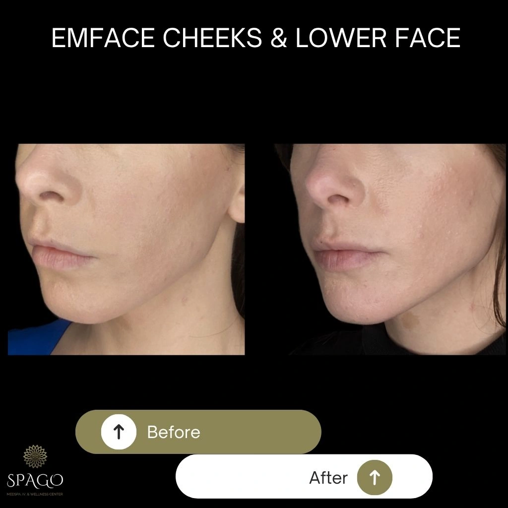 EMFACE SUBMENTUM (8)