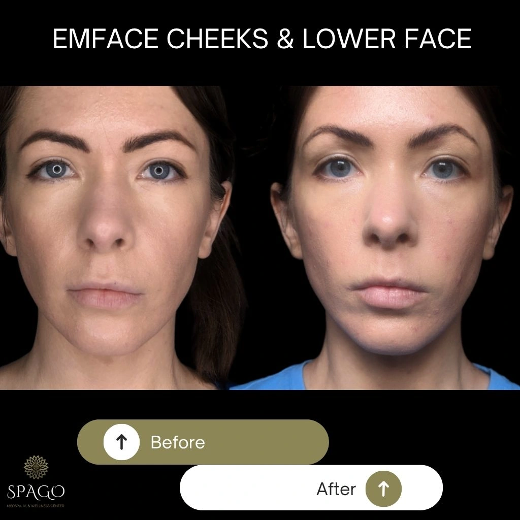EMFACE SUBMENTUM (9)