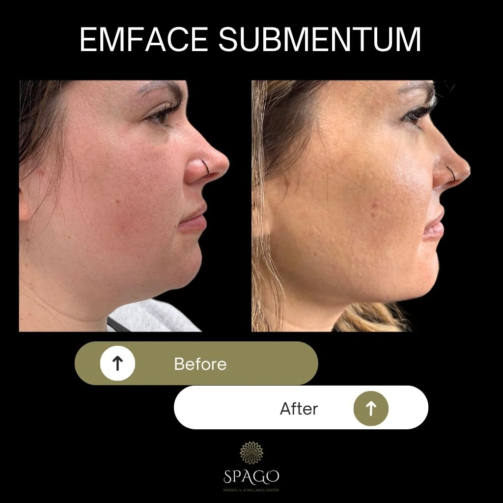 EMFACE SUBMENTUM