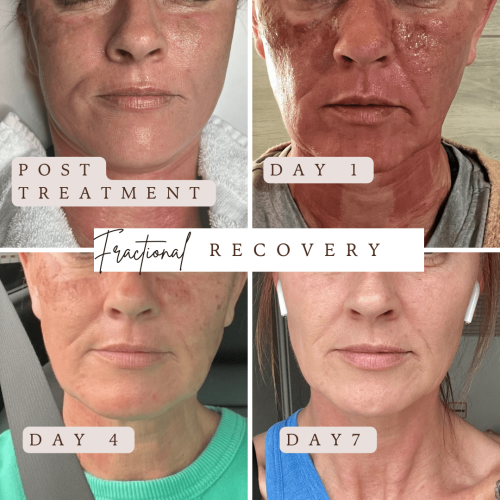 Moderate Fractional CO2 Recovery