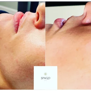 SpaGo MedSpa - RF Microneedling Before-After- In Erie Pa