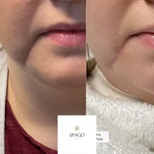 SpaGo MedSpa - RF Microneedling Before_After- In Erie Pa