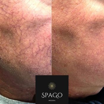 Laser Rosacea Treatment | Spago MedSpa in Erie, PA