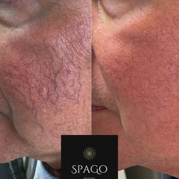 BBL and Rosacea treatment | Spago MedSpa in Erie, PA