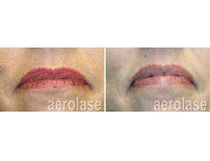 Neoclear Treatment Before and After Photo | SpaGo MedSpa in Erie, PA