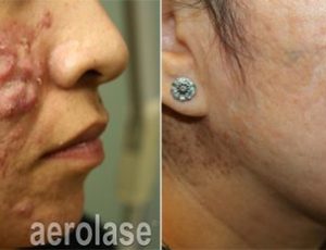 Neoclear before and after 2nd | Spago MedSpa in Erie, PA