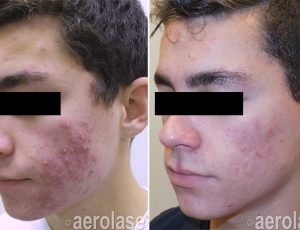 Neoclear before and after | Spago MedSpa in Erie, PA