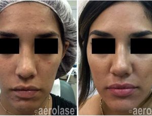 Medspa Neoclear Gallery before and after | Spago MedSpa in Erie, PA