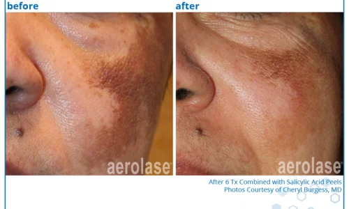 Pigment and spots before and after | Spago MedSpa in Erie, PA