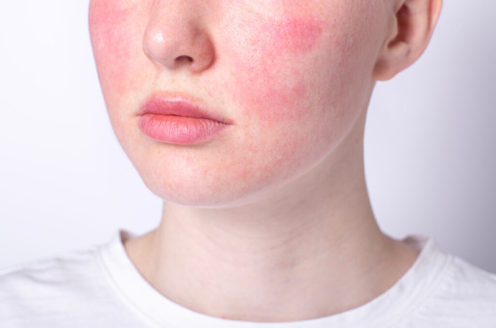 spagoerie Laser Rosacea Treatment in Erie PA