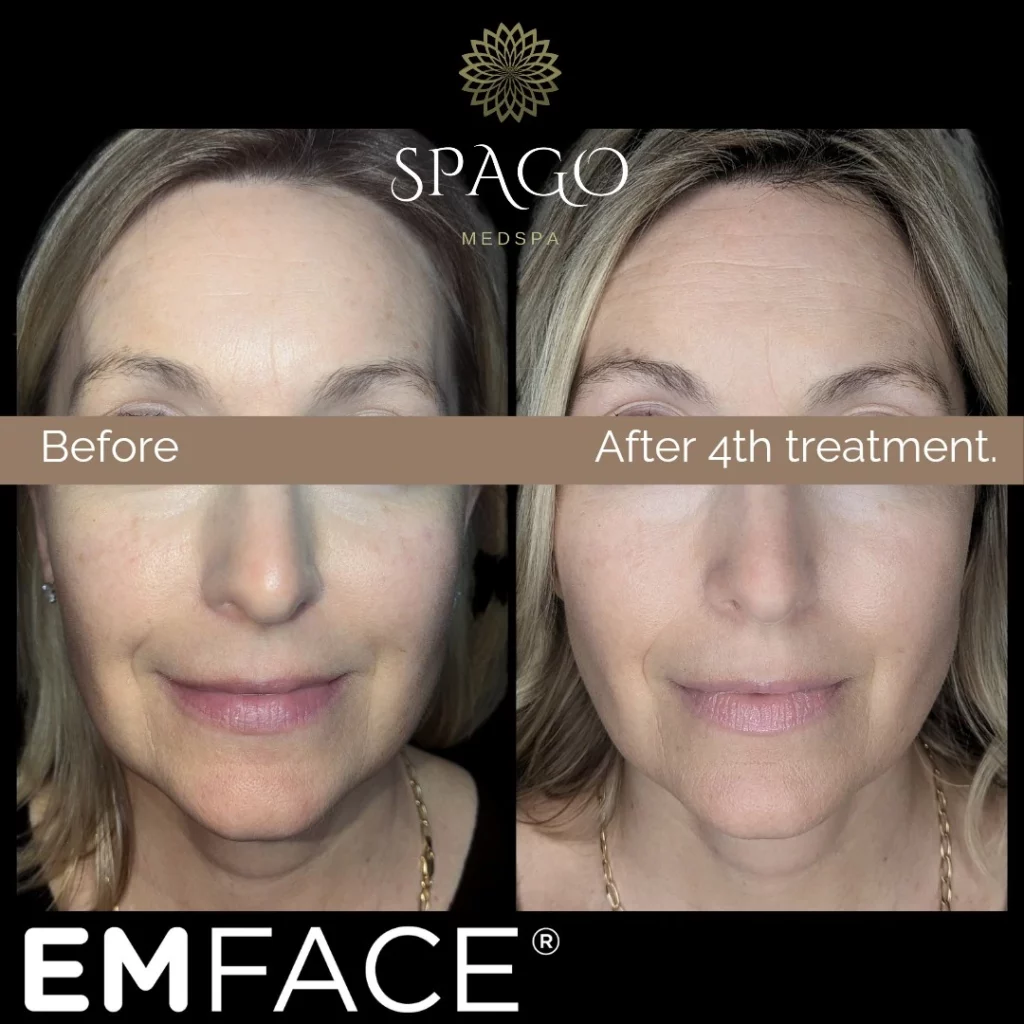 EMface Before & After Photo | SpaGo MedSpa in Erie, PA.