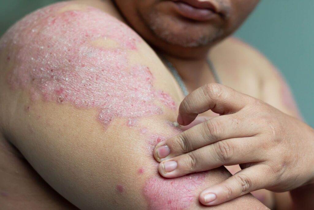 LASER PSORIASIS TREATMENT 2