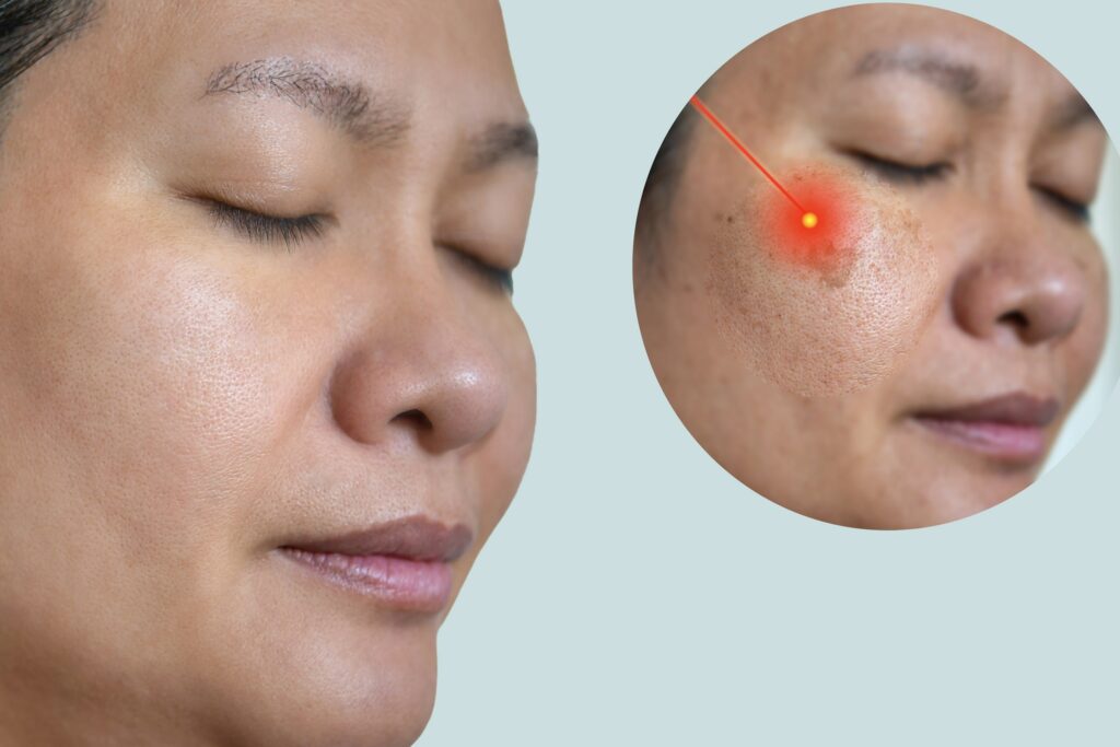 Laser Melasma Therapy min
